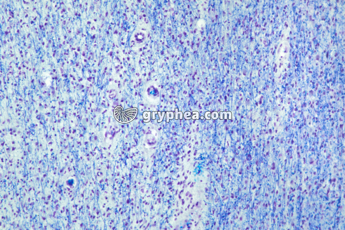 Sclérose en plaques - cerveau présentant des fibres nerveuses démyélinisées x40 - gryphea.com